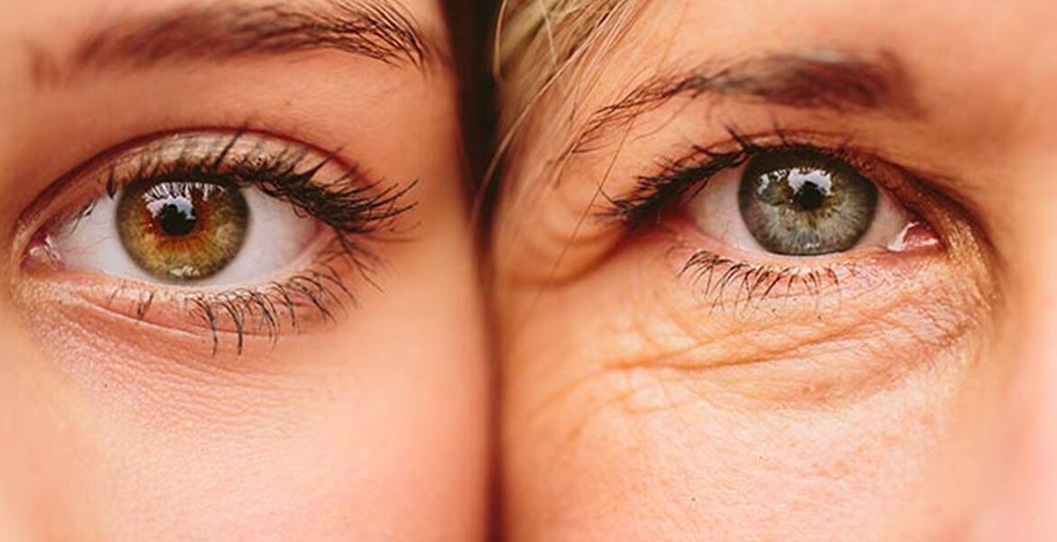 علائم خارجی پیری پوست دور چشم در دو زن در سنین مختلف